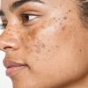 15_Most_Effective_Treatments_to_Fade_Stubborn_Dark_Spots-min_34c953dd-d93b-437e-9efc-28d9405f6487 | آرالیا | آرالیا شاپ